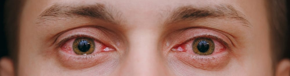 Why Does Weed Make Your Eyes Red?